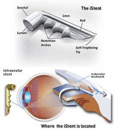 CIRUGÍAS MICROINVASIVAS PARA EL TRATAMIENTO DEL GLAUCOMA 